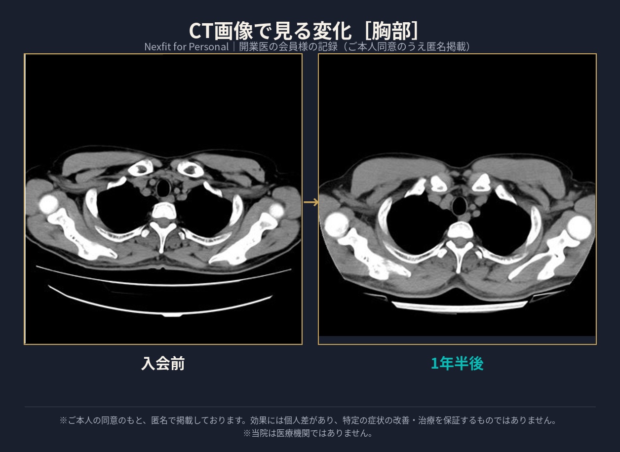 CT画像比較（胸部）入会前と1年半後の筋肉量の変化